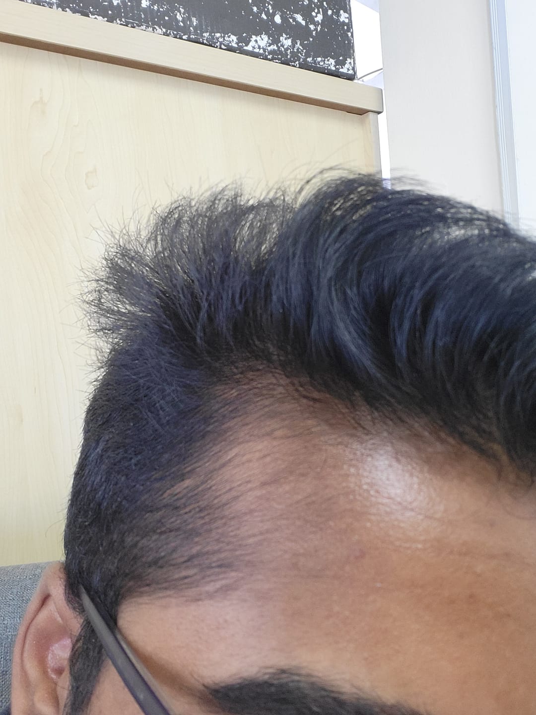 Customer photo review of Minoxidil DOUBLE ACTION FOAM, MEN ONLY 3x60ml Pack