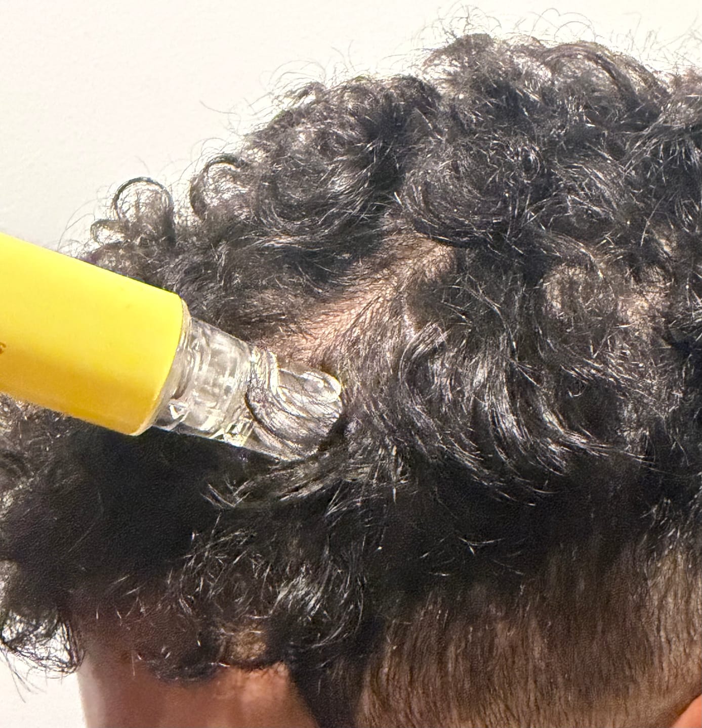 Customer photo review of The Magic Hair Growth Serum with Micro-Needle Applicator