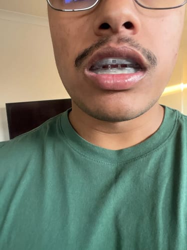 Customer photo review of Honex™ Anti-Snoring Mouth Guard