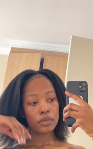 Customer photo review of Minoxidil 5% Solution, 1 Pack 60ml