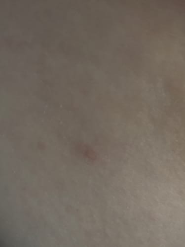 Customer photo review of THE VIRAL SUPER STICK - targets skin tags • keratosis • moles • sun damage • stubborn blemishes