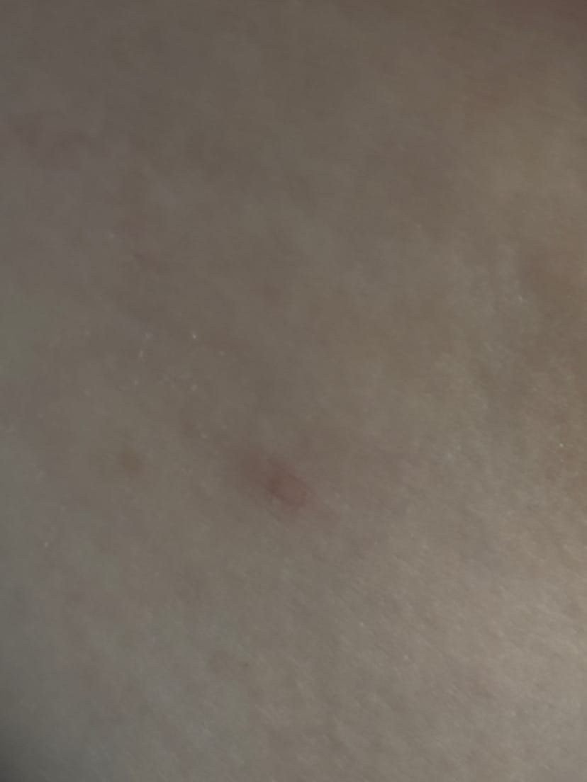 Customer photo review of THE VIRAL SUPER STICK - targets skin tags • keratosis • moles • sun damage • stubborn blemishes