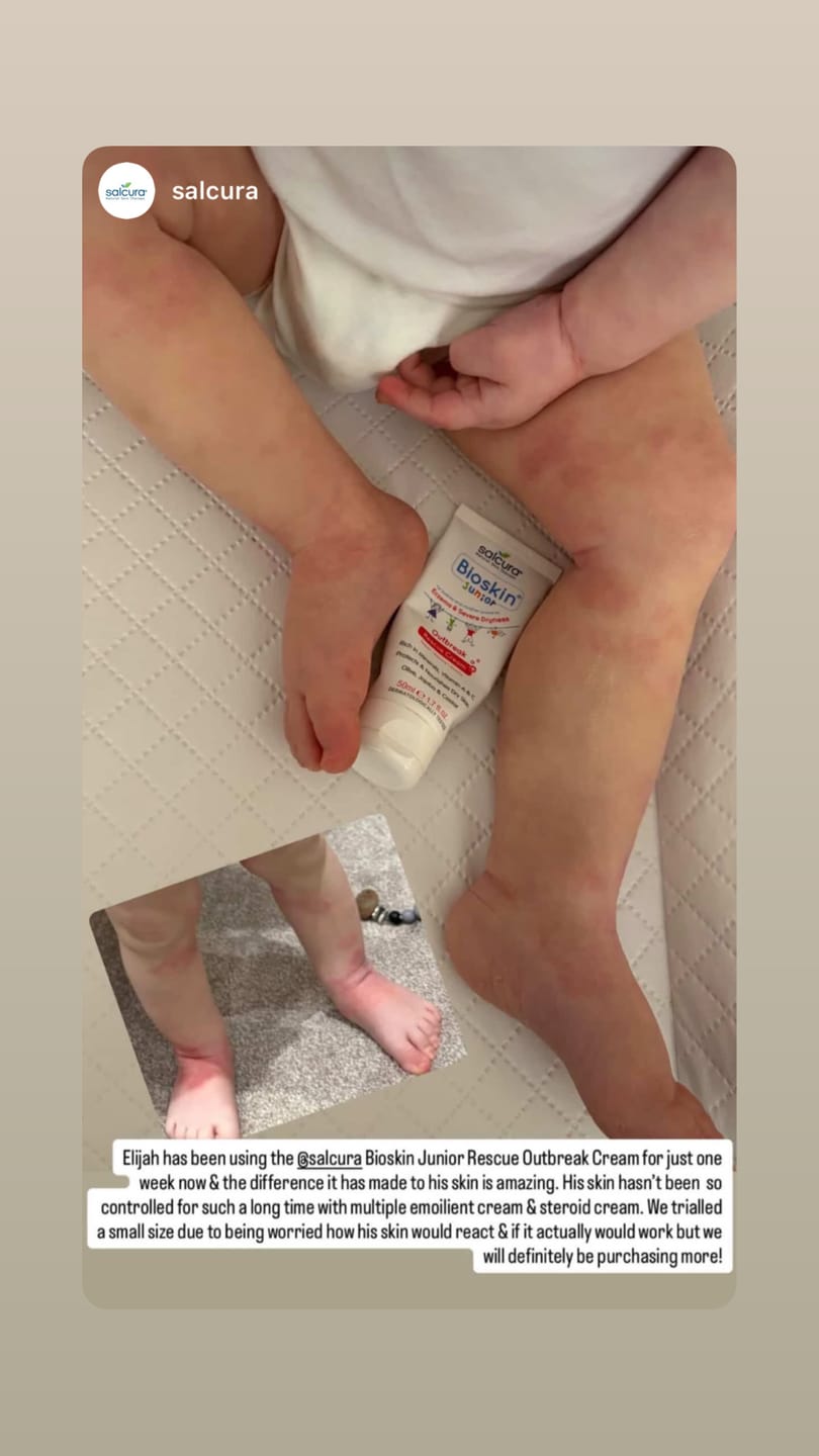Customer photo review of Bioskin Junior Outbreak Rescue Cream