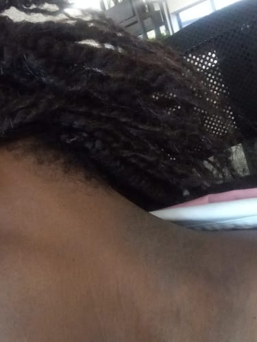 Customer photo review of Minoxidil 5% SOLUTION, 3x60ml pack