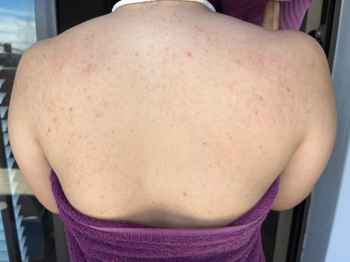 Customer photo review of Bumps Be Gone