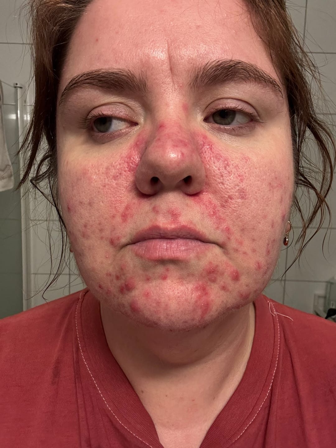 Customer photo review of NINE LESS A-Control 10% Azelaic Acid Serum