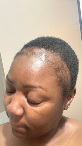 Customer photo review of Minoxidil5% Solution, 1 Pack 60ml