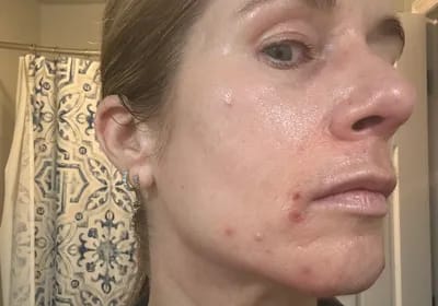 Customer photo review of CLEAR Mindbodyskin® Equilibrio hormonal interno elimina el acne de raiz