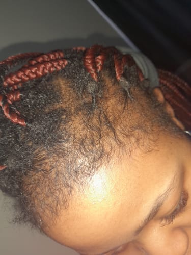 Customer photo review of Minoxidil 5% SOLUTION, 3x60ml pack