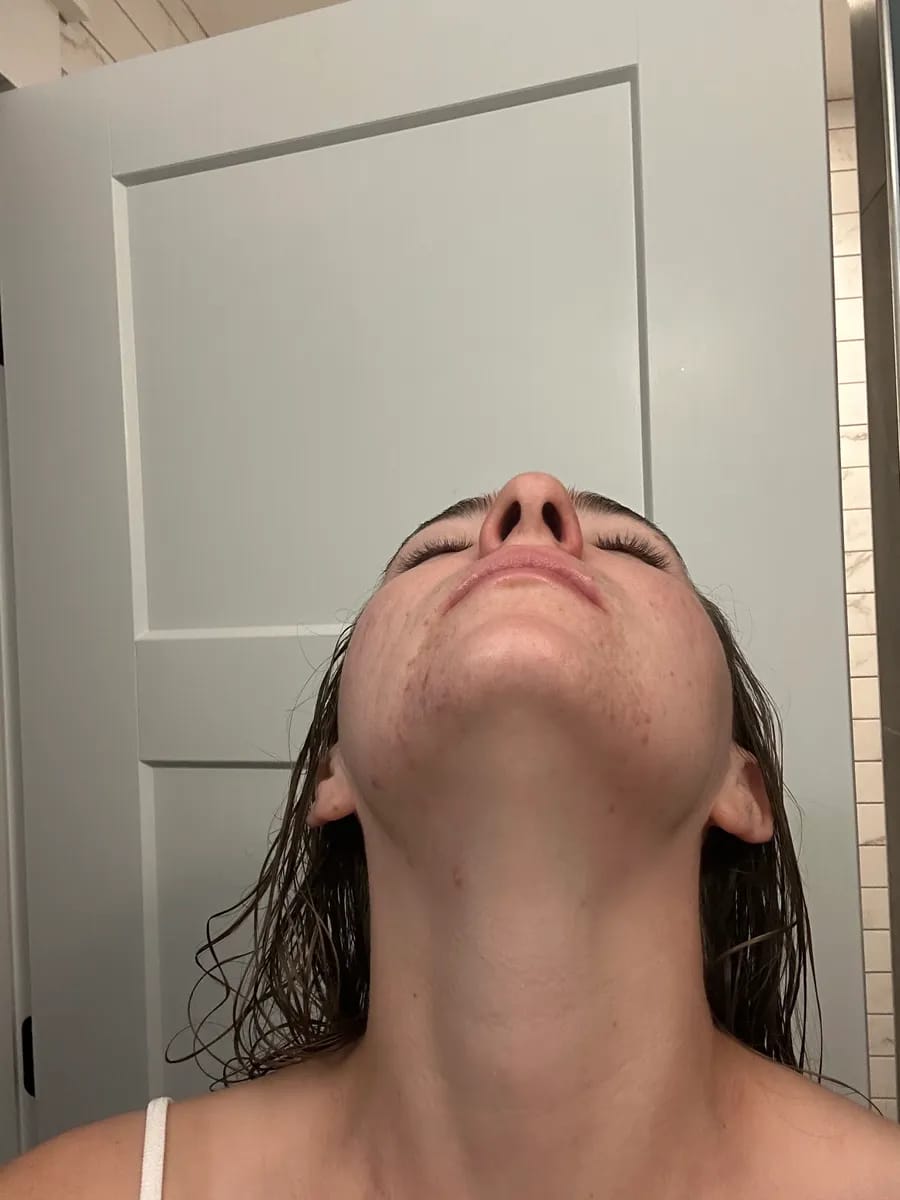 Customer photo review of CLEAR Mindbodyskin® Equilibrio hormonal interno elimina el acne de raiz