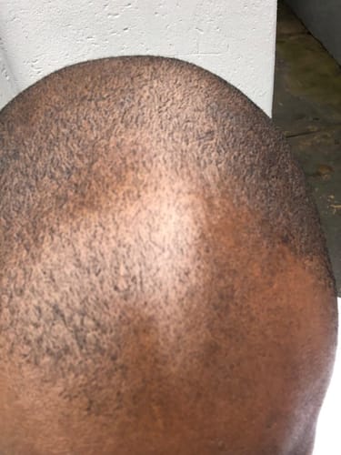 Customer photo review of Minoxidil+DHT Blocker Solution - MEN ONLY, 3x60ml pack