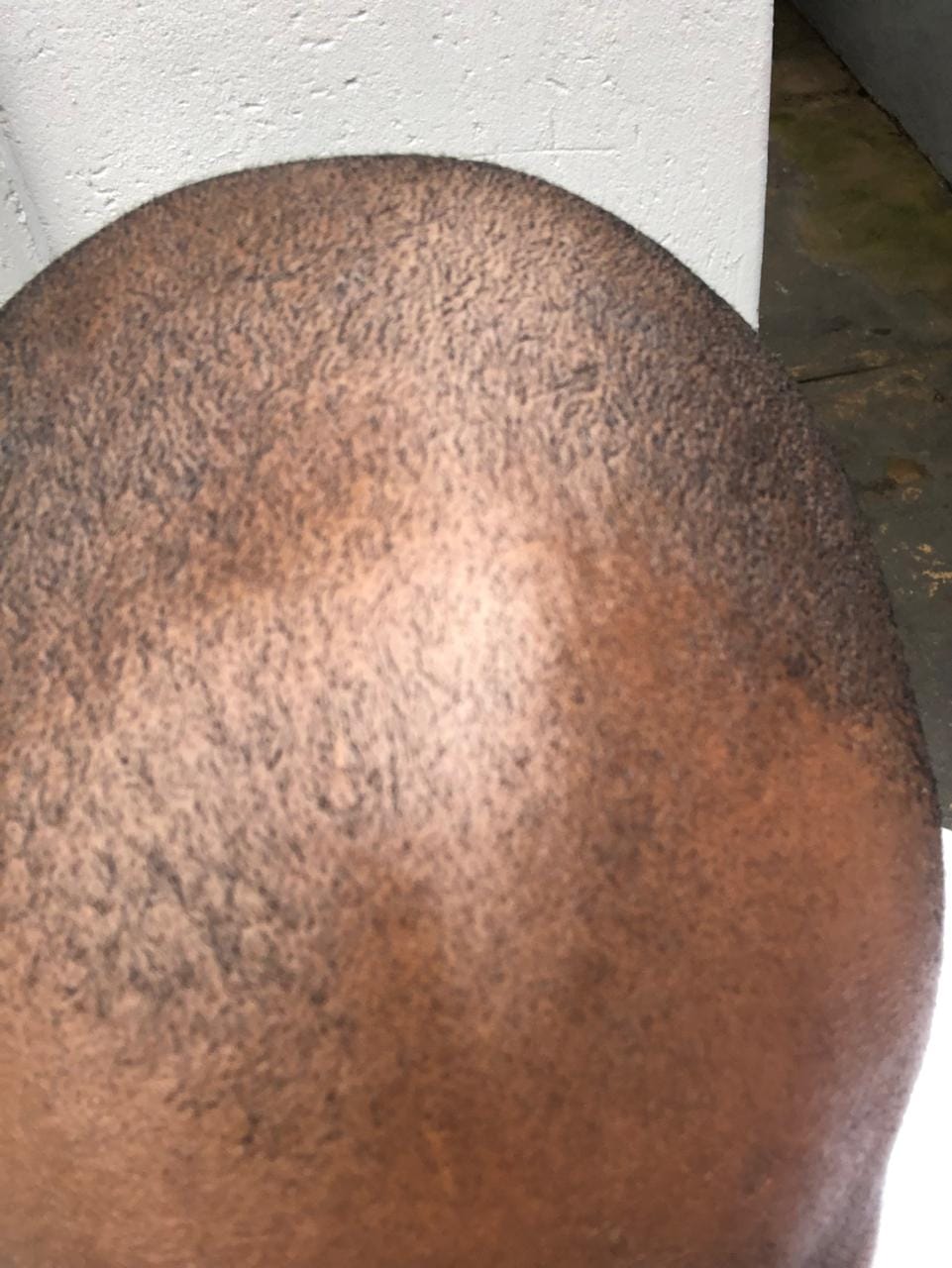 Customer photo review of Minoxidil+DHT Blocker Solution - MEN ONLY, 3x60ml pack