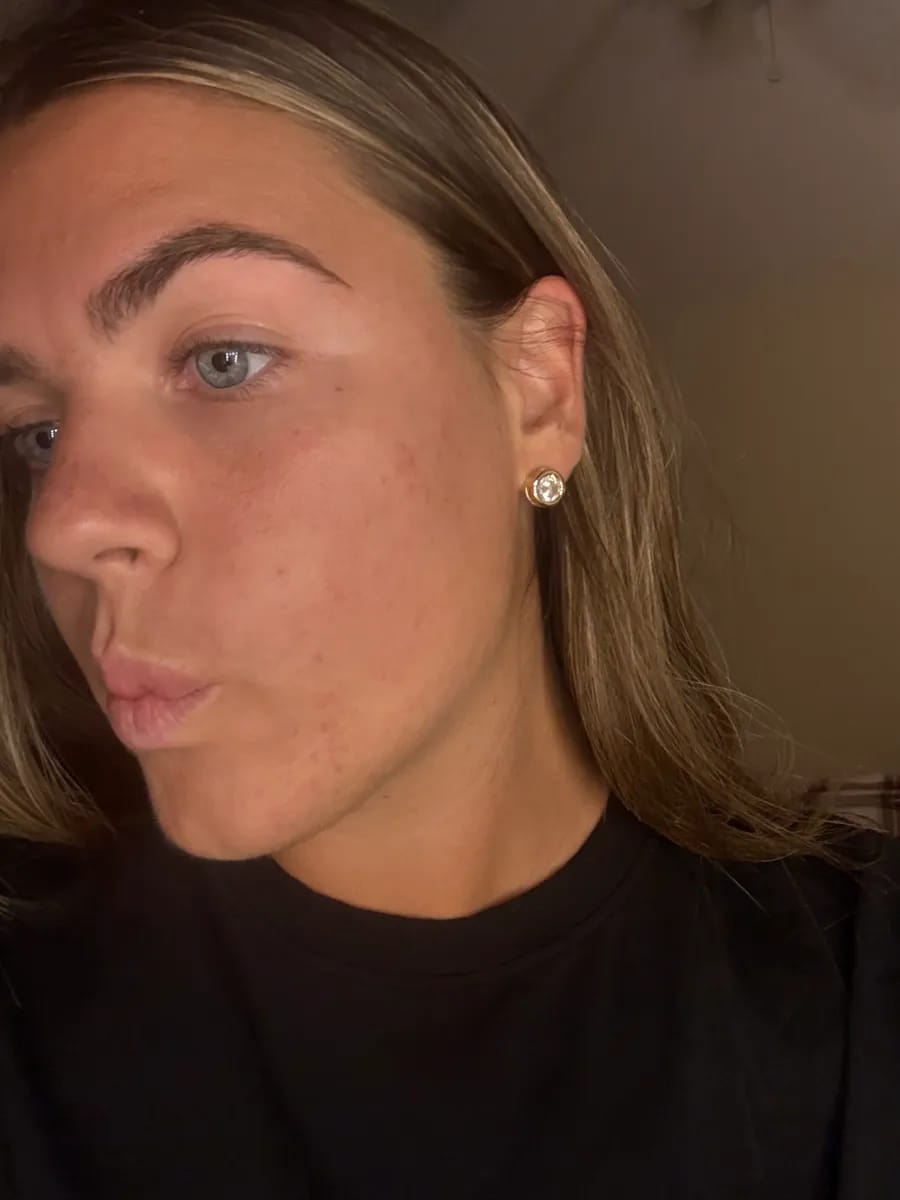 Customer photo review of CLEAR Mindbodyskin® Equilibrio hormonal interno elimina el acne de raiz