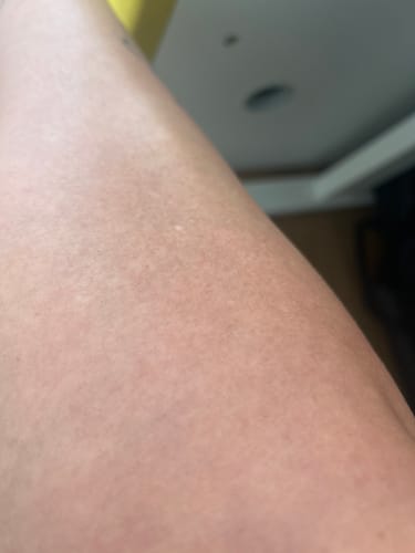 Nahaufnahme des Beins eines Rezensenten 3 Tage nach der Anwendung des Haarentfernungsschaums.