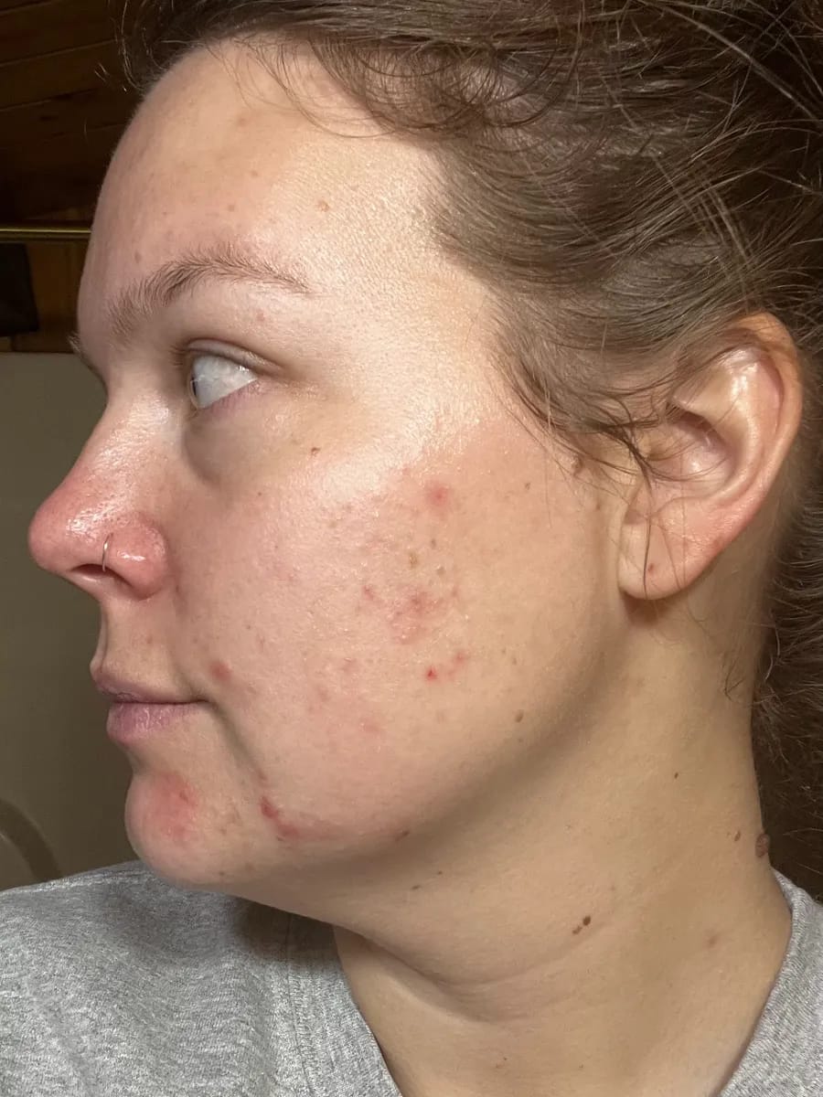 Customer photo review of CLEAR Mindbodyskin® Equilibrio hormonal interno elimina el acne de raiz