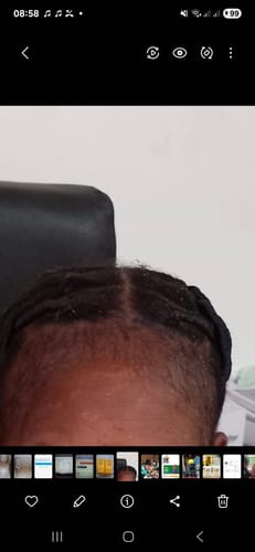 Customer photo review of Minoxidil High Strength (5%) SOLUTION, 3x60ml pack