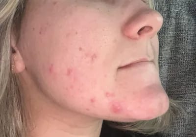 Customer photo review of CLEAR Mindbodyskin® Equilibrio hormonal interno elimina el acne de raiz