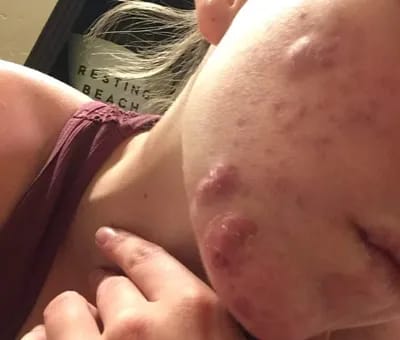 Customer photo review of CLEAR Mindbodyskin® Equilibrio hormonal interno elimina el acne de raiz