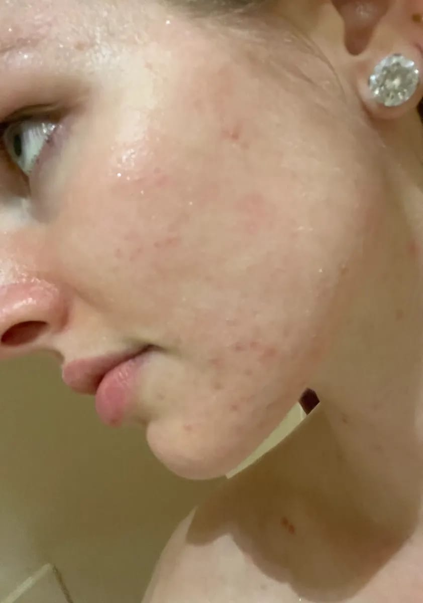 Customer photo review of CLEAR Mindbodyskin® Equilibrio hormonal interno elimina el acne de raiz