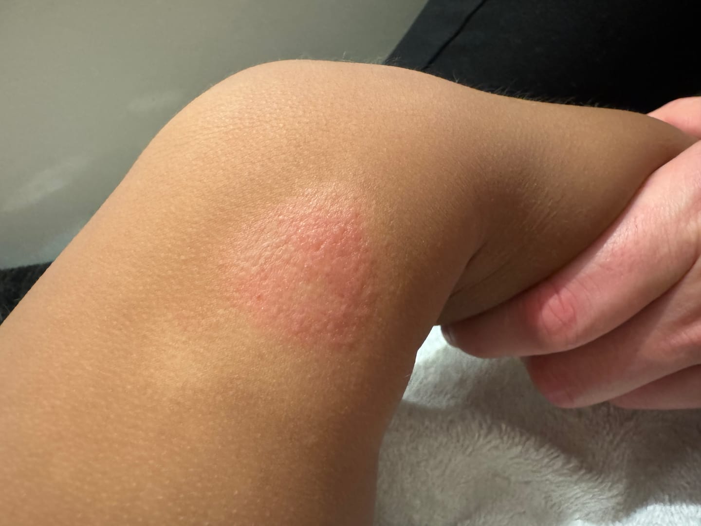 Customer photo review of Beezema Eczema Cream