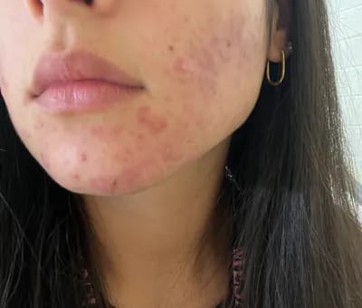Customer photo review of CLEAR Mindbodyskin® Equilibrio hormonal interno elimina el acne de raiz