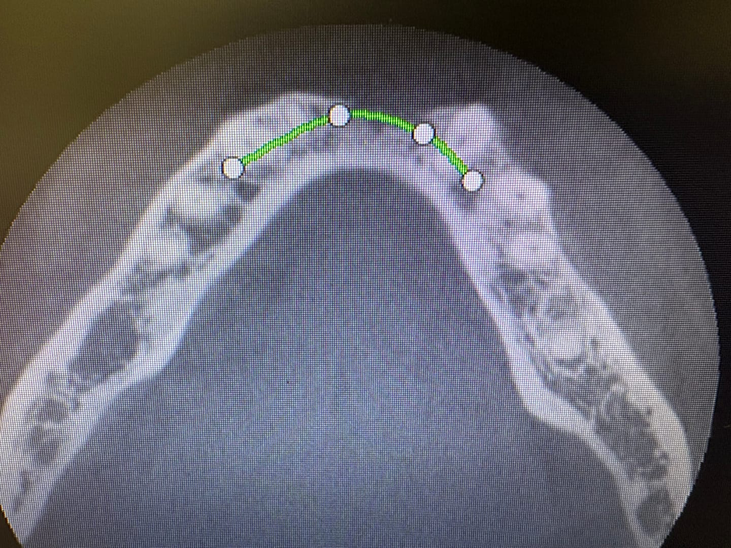 Customer photo review of ALTO® One-Piece Dental Implant Ø4.0 - Monoblock System