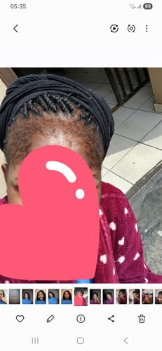 Customer photo review of Minoxidil High Strength (5%) FOAM, 3x60ml pack