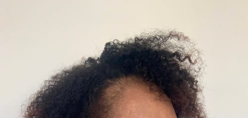 Customer photo review of Minoxidil 5% Solution, 1 Pack 60ml