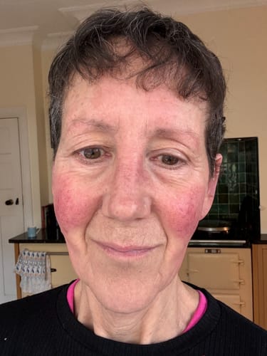 Customer photo review of Creams Set - FREE Miracle Formula