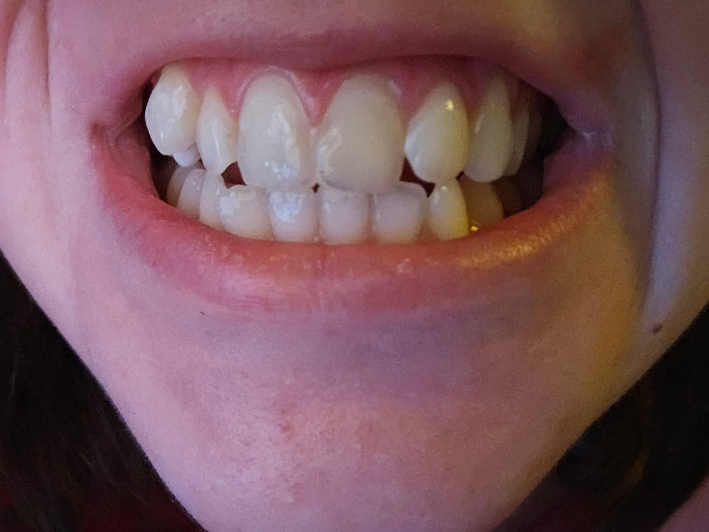 Customer photo review of Bandes Kauka Smile (sans peroxyde)