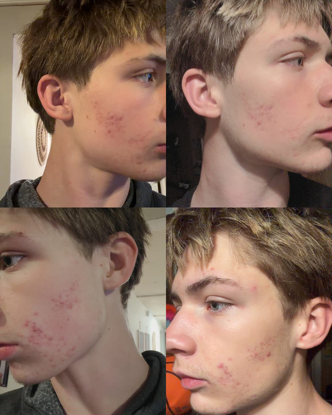 Customer photo review of The Complete Acne Killer System 2.0