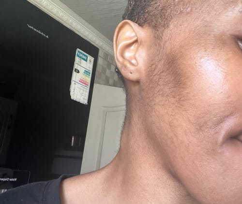 Customer photo review of Minoxidil High Strength (5%) SOLUTION, 3x60ml pack