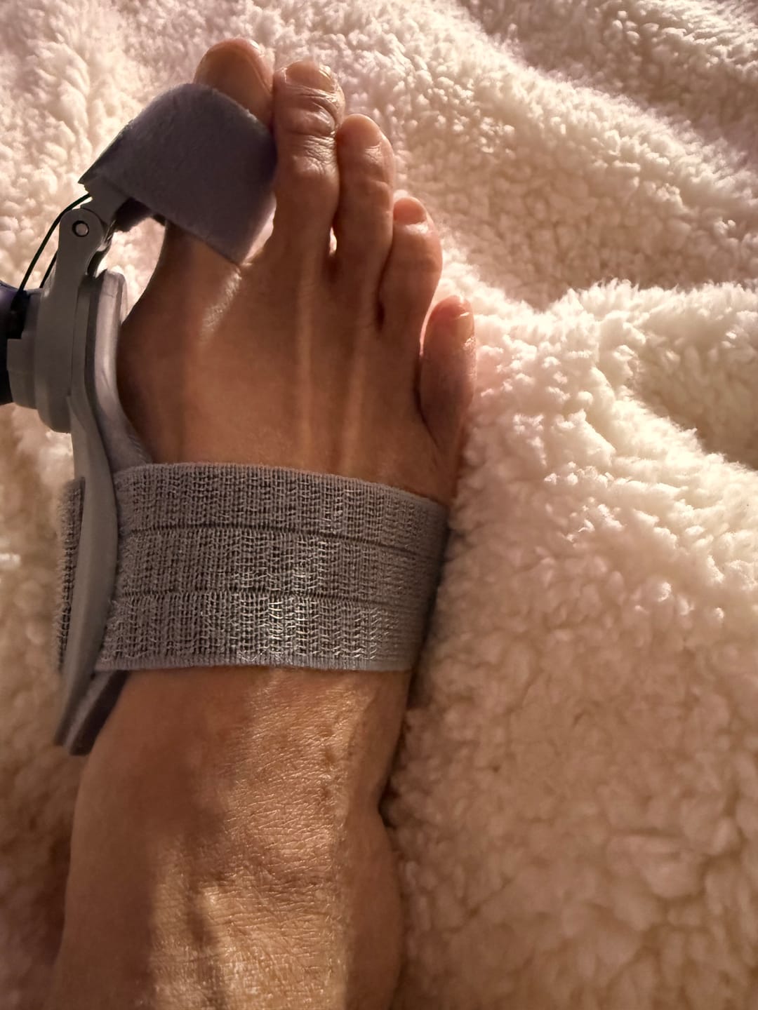 Customer photo review of Treatmedy™ Bunion Fix