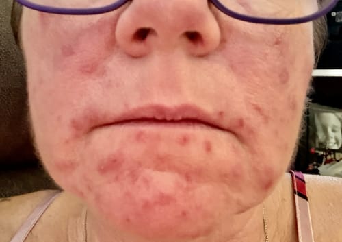 Close-up of a reviewer's red, blemished skin before using the 5-Step Clear Skin Kit.