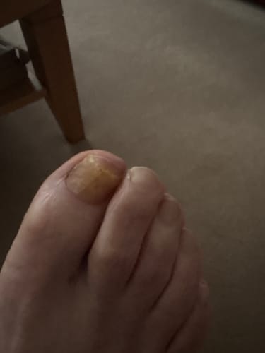Close-up of a customer's big toenail, which is yellow and thick from a fungal infection being treated.
