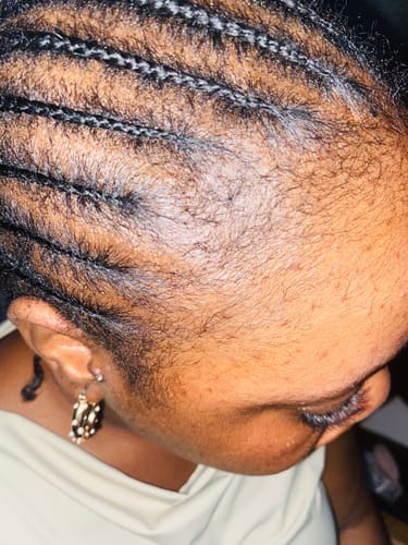 Customer photo review of Minoxidil 5% Solution, 1 Pack 60ml