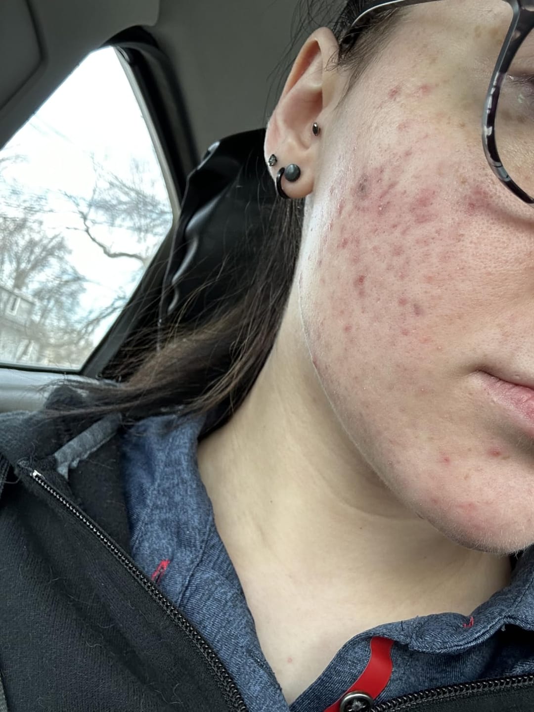 Customer photo review of CLEARSTEM® La solucion interna para el acne hormonal
