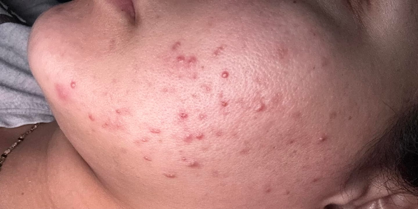 Customer photo review of CLEARSTEM® La solucion interna para el acne hormonal