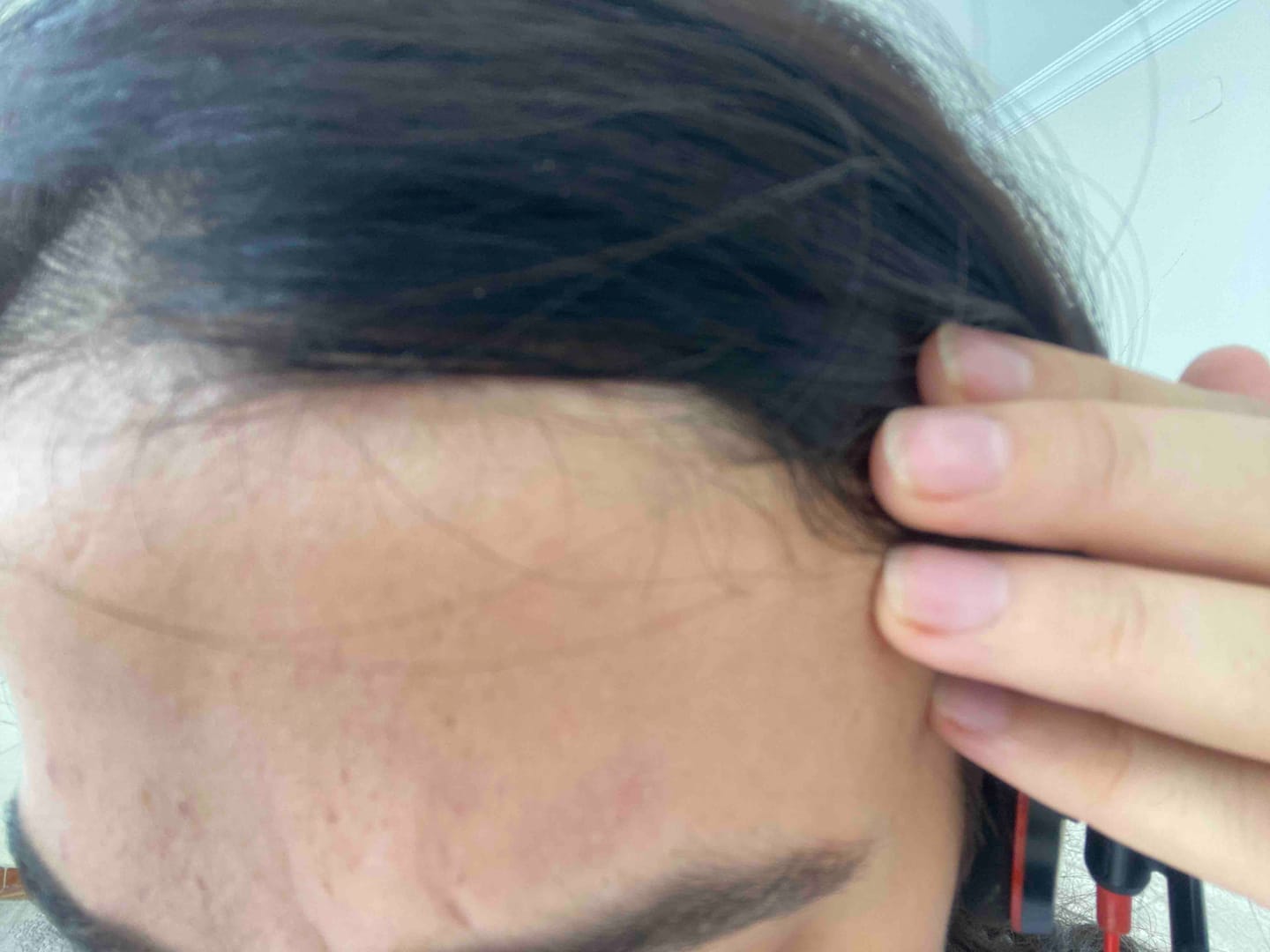 Customer photo review of Akne Karşıtı Losyon