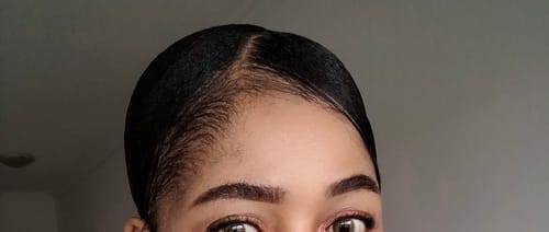 Customer photo review of Minoxidil High Strength (5%) SOLUTION, 3x60ml pack