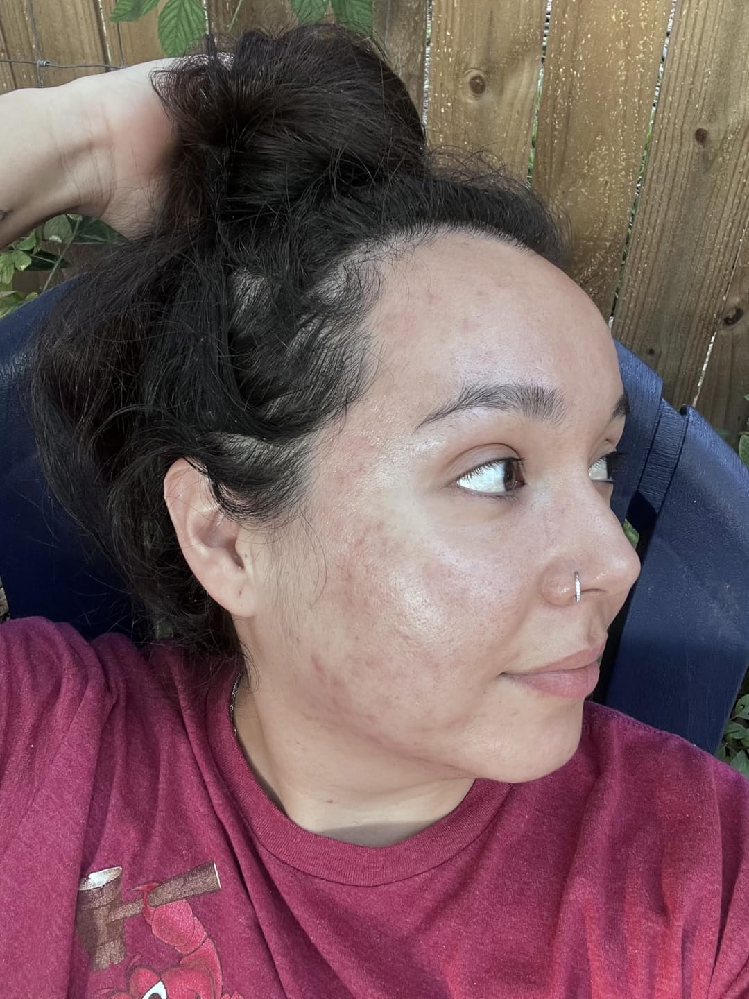 Customer photo review of CLEARSTEM® La solucion interna para el acne hormonal