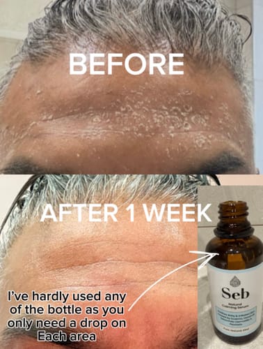 Customer photo review of Seb Natural Calming Serum