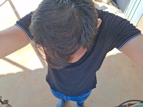 Customer photo review of Minoxidil DOUBLE ACTION FOAM, MEN ONLY 3x60ml Pack