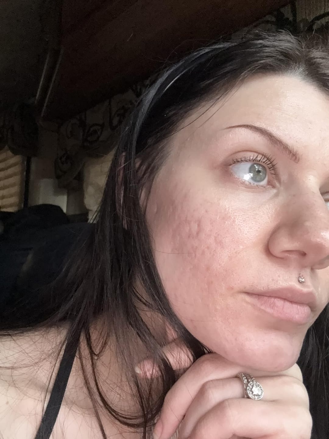 Customer photo review of CLEARSTEM® La solucion interna para el acne hormonal