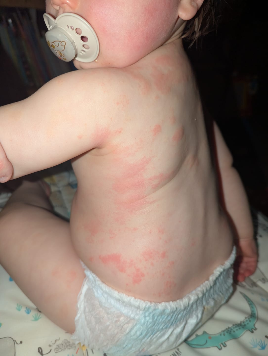 Customer photo review of Bioskin Junior Outbreak Rescue Cream