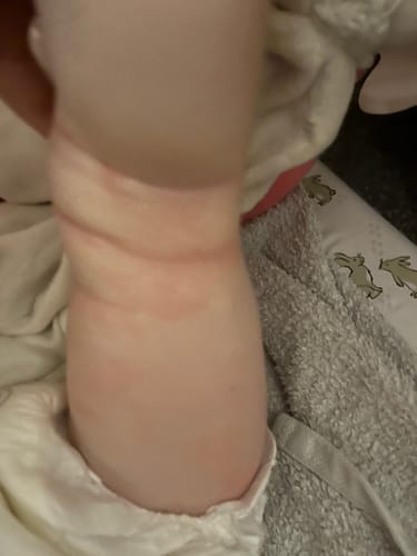 Customer's photo of a baby's arm showing clearer, soothed skin after using Calm Cream for eczema.