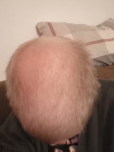 Customer photo review of Minoxidil High Strength (5%) SOLUTION, 3x60ml pack