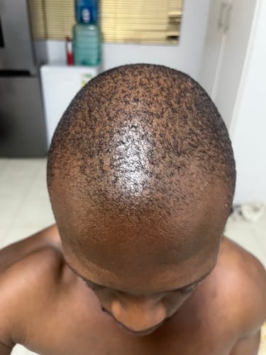 Customer photo review of Minoxidil DOUBLE ACTION Solution - MEN ONLY, 3x60ml pack