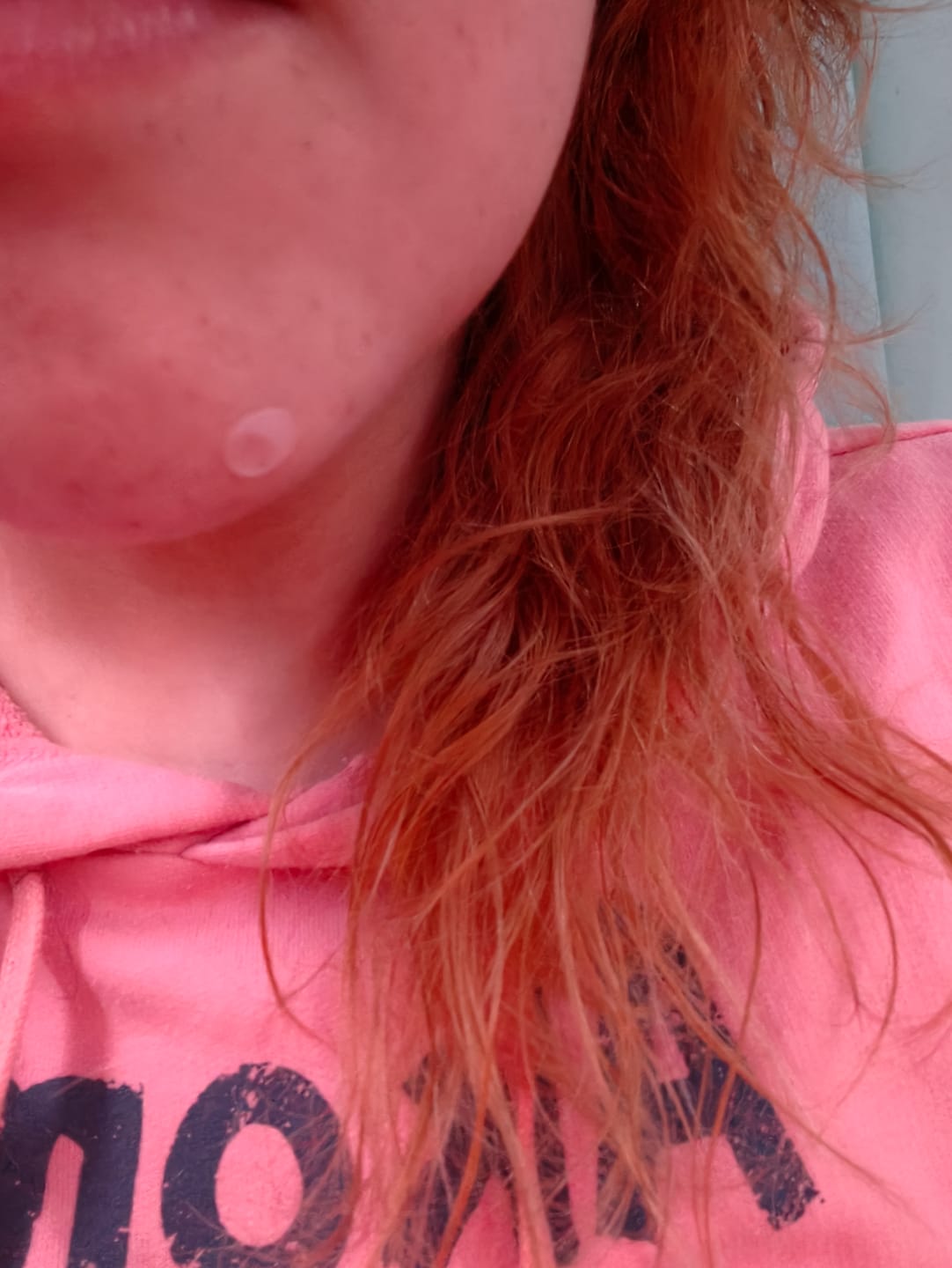 Customer photo review of Acne Pimple Master Patch