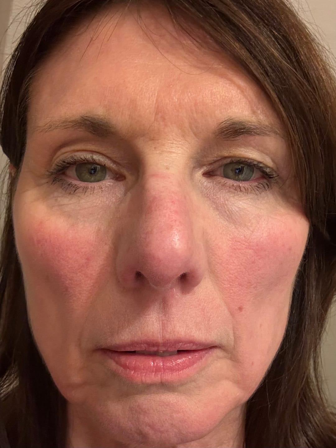 Customer photo review of Rosalique 3 in 1 Anti-Redness Miracle Formula SPF50